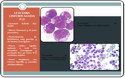 Leucemia Linfoide Aguda