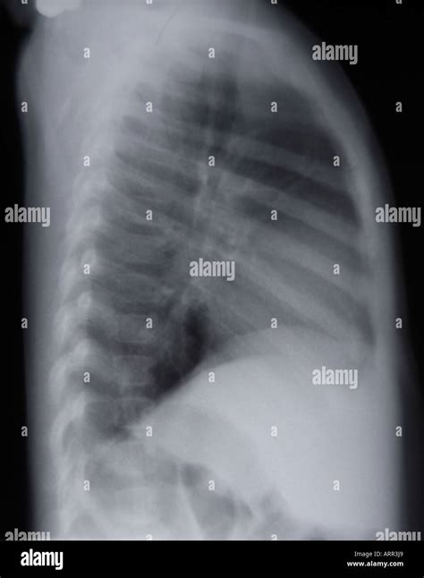 Normal Chest X Ray Side View