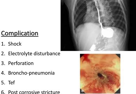 Caustic ingestion-esophageal stricture محاضره 2.pptx | Free Download