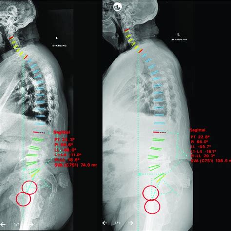 Case Treated With Pre Psoas Interbody Fusion For L4 5 Spondylolisthesis