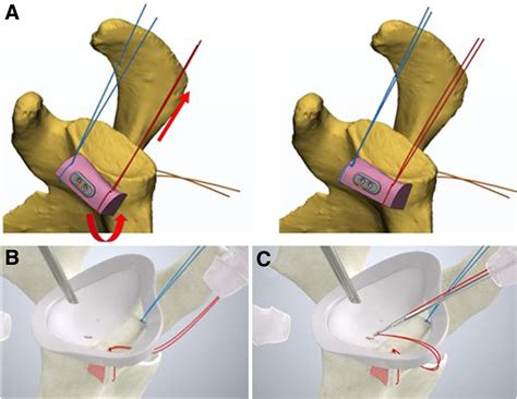 All Arthroscopic Glenoid Bone Augmentation Using Iliac Crest Autograft Procedure For Recurrent