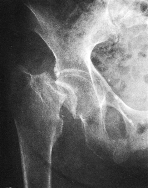 Secondary Fracture Prevention Program Initiative