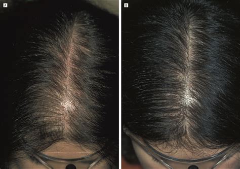 Hair Loss Treatment For Women