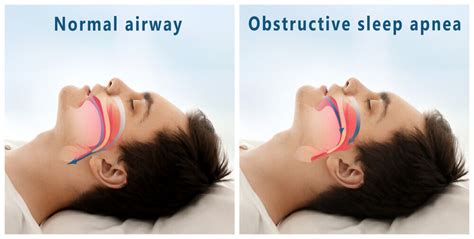 Sleep Apnea Rhode Island Dental Arts