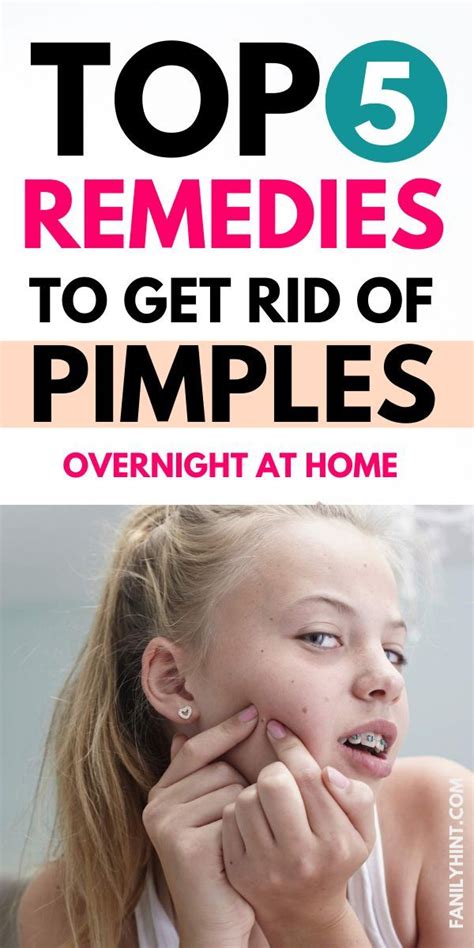 How To Get Rid Of Pimples Overnight 10 Home Remedies For Pimples Artofit