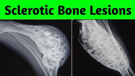 Multiple Sclerotic Bone Lesions Differential Diagnosis YouTube