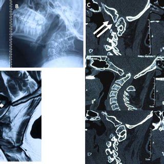 (PDF) Is Transoral Surgery Still a Relevant Procedure in Atlantoaxial ...