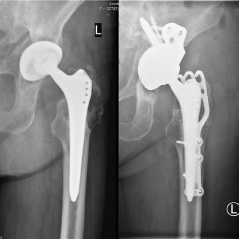 Pre And Post Operative Frontal View Radiographs Of A Female Patient Download Scientific Diagram