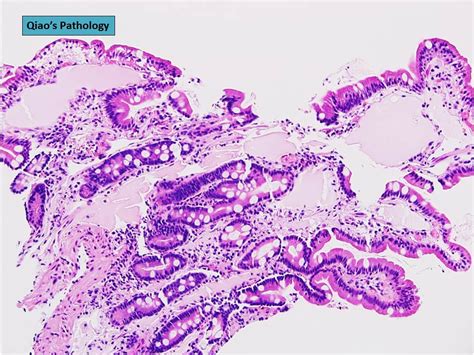 Qiao's Pathology: Primary Intestinal Lymphangiectasia | Flickr