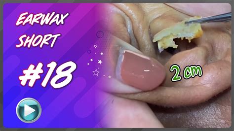 Remove Earwax Asmr Ear Cleaning Esp 18 Youtube