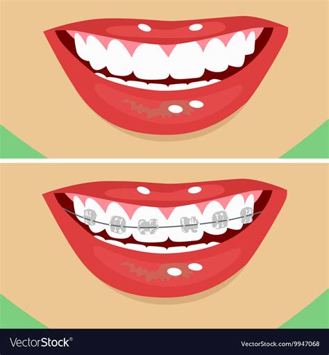 Dental braces before and after Royalty Free Vector Image