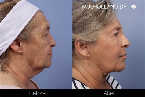 Cheek Lift Surgery Mid Facelift Toronto Plastic Surgeons