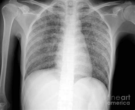 Miliary Tuberculosis Photograph by Rajaaisya/science Photo Library - Pixels