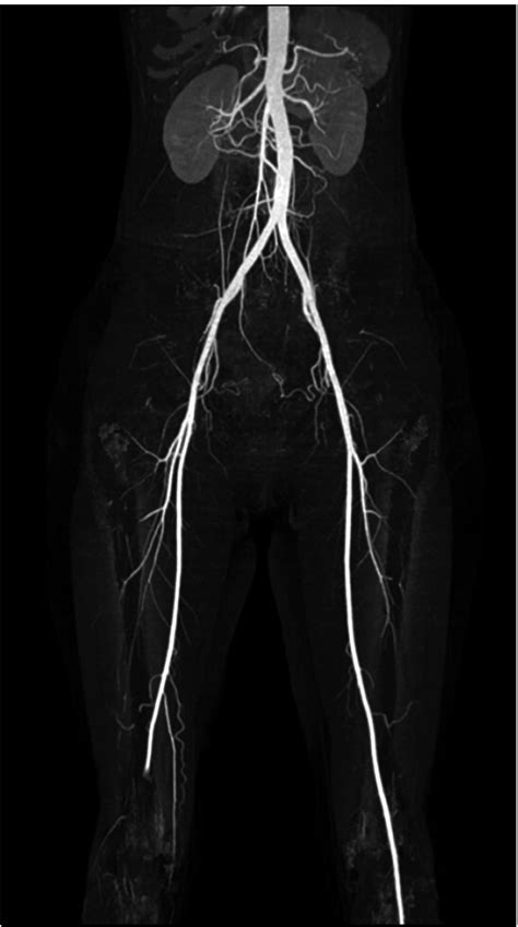 Lower Extremity Arteries Cta