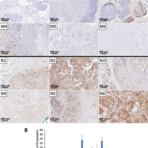 Sfrp Protein Expression Ihc In Cmts With And Without Metastasis A