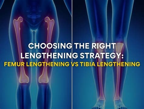 Choosing The Right Limb Lengthening Strategy Femur Vs Tibia Lengthening