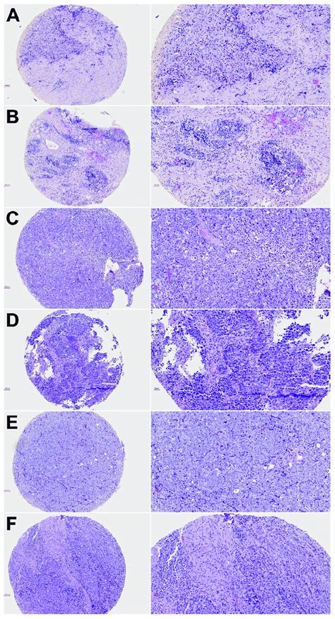 Hematoxylin And Eosin Stainings Of Representative Cases From Tumor