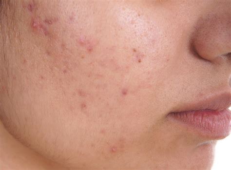 Relax With Squeeze Acne Celebs News