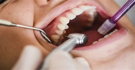 Qué es un curetaje dental para qué sirve y cuándo se hace