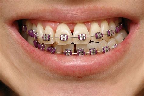 Favorite Color Like Purple Teeth Braces Braces Teeth Colors Braces