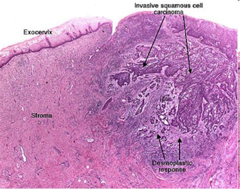 Histology: Cervical Cancer