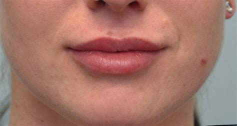 Lip Injections And Augmentation Calgary Lip Fillers Preventous