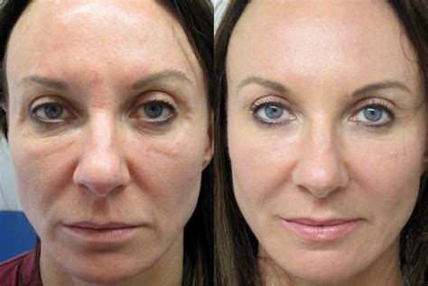 Vampire Facelift Insight Derma Clinic