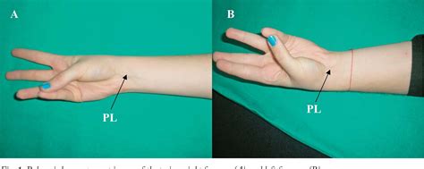 Figure 1 From PALMARIS LONGUS ABSENT IN ONE IDENTICAL TWIN A CASE