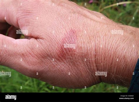 Burn hand hi-res stock photography and images - Alamy