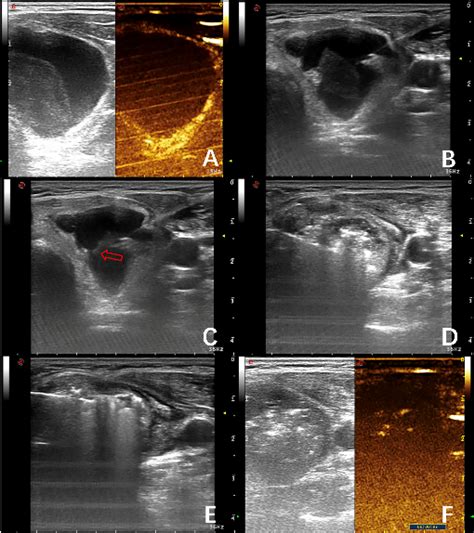 Frontiers Analysis Of Risk Factors For Intra Cystic Hemorrhage In