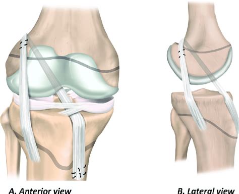 Physeal Sparing Acl Reconstruction Using An Over The Top Technique With