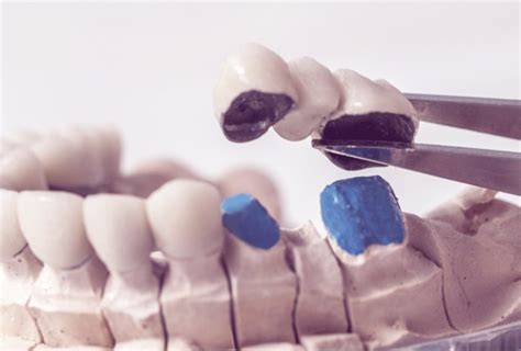 Dental Bridges Procedures 3 Types False Teeth Restoration