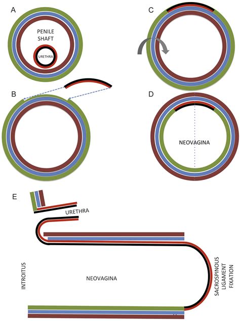 Surgical Reconstruction For Male To Female Sex Reassignment European Urology