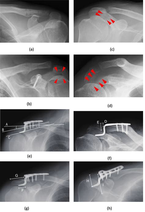 Posterior Positioning Of A Clavicle Hook Plate Is A Risk Factor For