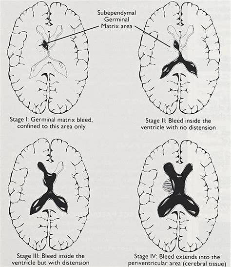 Germinal Matrix Brain Anatomy