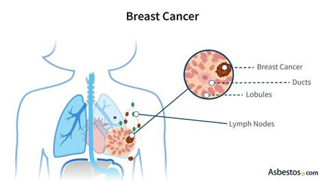 Spatial Maps Of Genetically Diverse Breast Cancer Cells Atelier Yuwa