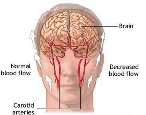 Ice Pick Headaches - Treatment, Causes, Symptoms, Remedies