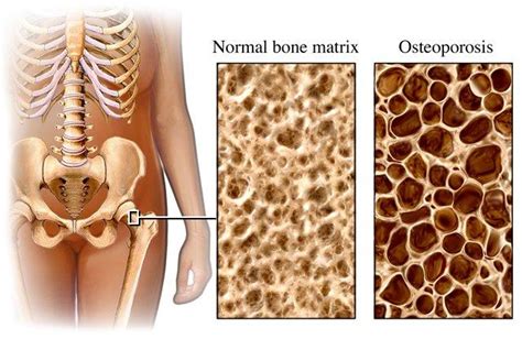 Detecting Osteoporosis 检测骨质疏松症 Bone Clinic Neurosurgeon