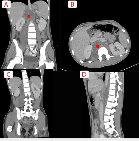 A Axial And B Sagittal View Of A CT Scan Of Abdomen An Pelvis