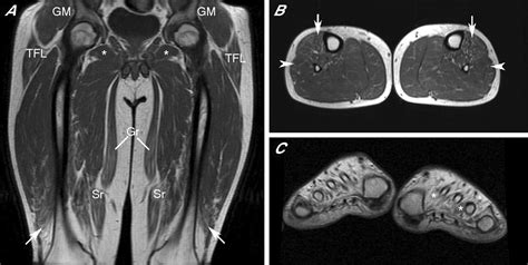 Charcot Marie Tooth Disease Type 1a Duplication With Severe Paresis Of The Proximal Lower Limb