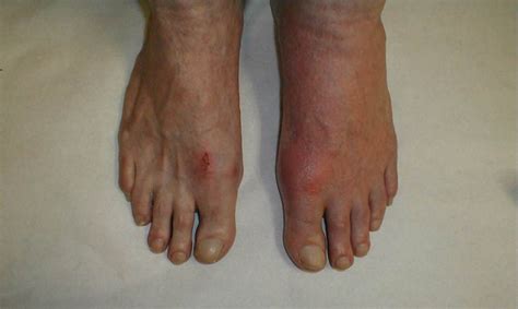 Diabetic foot rash pictures | Symptoms and pictures