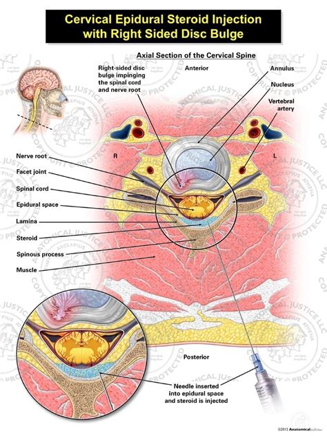 Cervical Epidural Steroid Injection With Right Disc Bulge