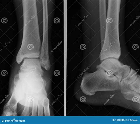 X Ray Ankle Ap Lateral Stock Photo Image Of Fibula 102024542