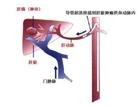 【医救治】微创介入的三把利器，让肝癌无处可逃！