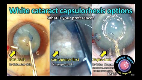 Cataractcoach White Cataract Capsulorhexis Options Youtube