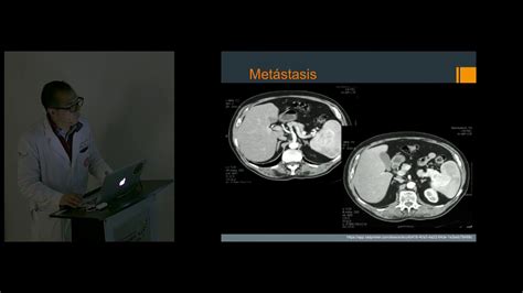 Diagn Stico Diferencial De Masas Espl Nicas Dr Eduardo Rangel Youtube