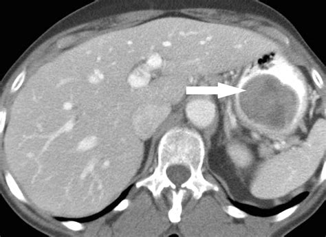 Gastrointestinal Stromal Tumors Clinical Radiologic And Pathologic