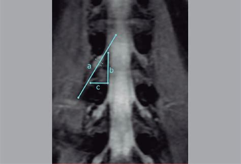 Scielo Brasil Evaluation Of The Lumbar Safety Triangle Through