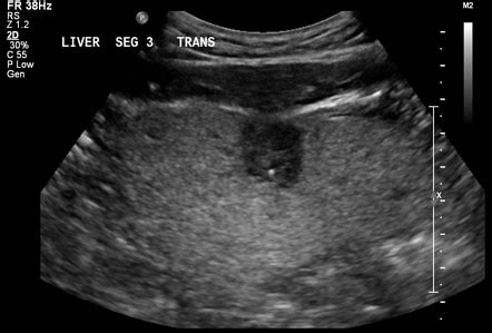 Hepatic Hemangioma Ceus Image Radiopaedia Org