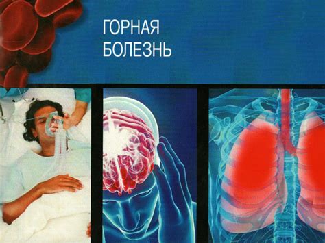 Горная болезнь